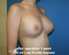plastic-surgery-breast-augmentation
